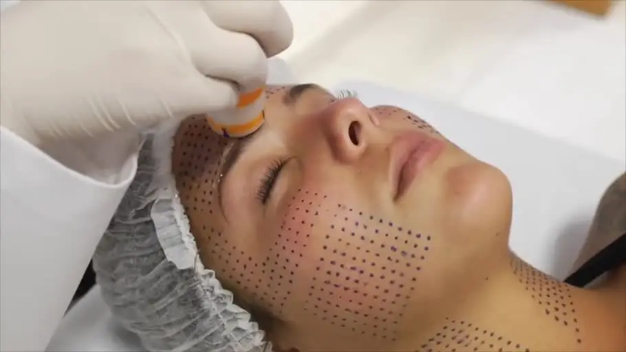 ultrassom-microfocado-facial-santos
