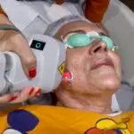 Aplicação laser Pisom facial