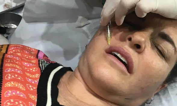 preenchimento labial